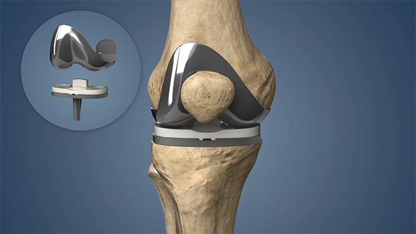 The Future of Knee Surgery: Embracing Technological Innovations