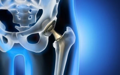 Hip Resurfacing Arthroplasty