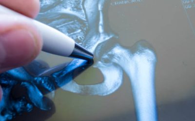 Hip Arthroscopy