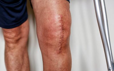 Total Knee Replacement