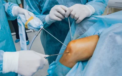 Knee Arthroscopy
