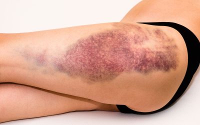 Soft Tissue Injuries
