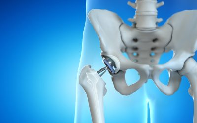 Direct Anterior Approach Hip Replacement