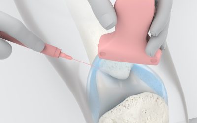 Arthrosamid Injection