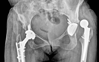 Dislocations