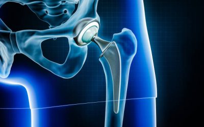 Primary Hip Replacement