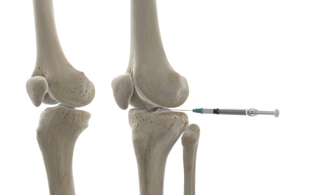 Is Arthrosamid Safe? Risks, Side Effects, and What to Expect