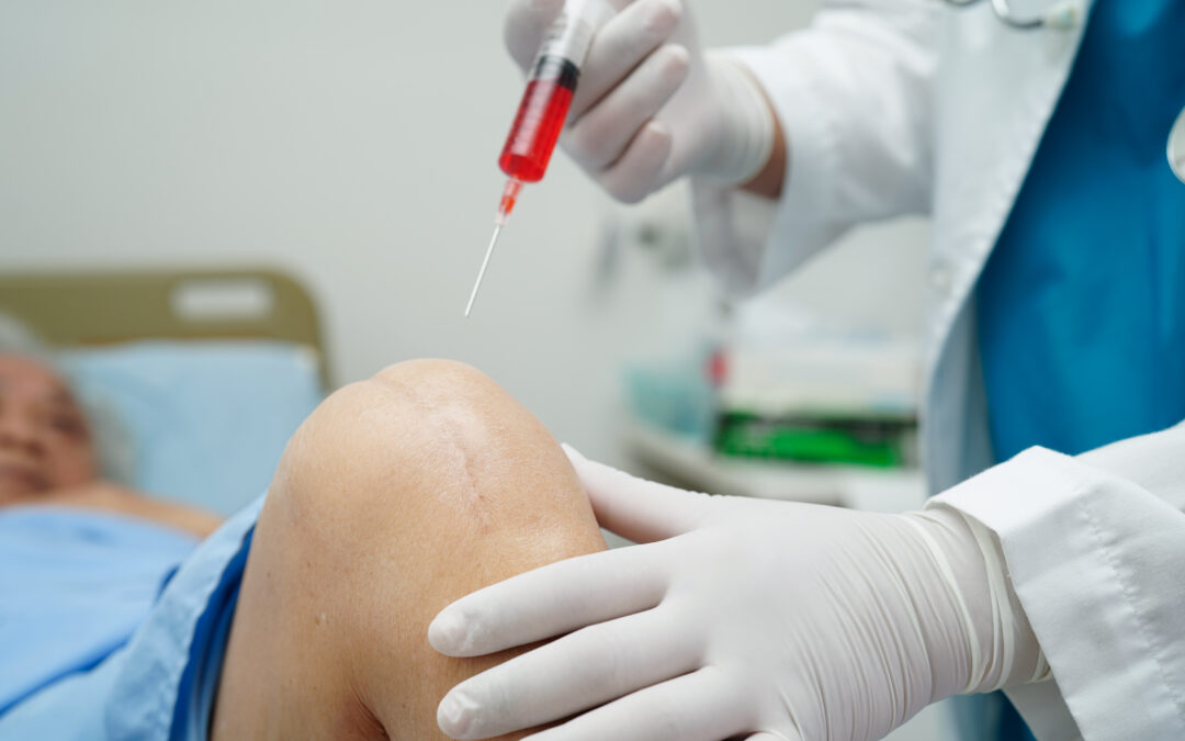 The Science Behind Arthrosamid: How One Injection Can Tame Osteoarthritis