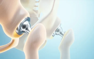 What to Expect From Minimally Invasive Hip Surgery